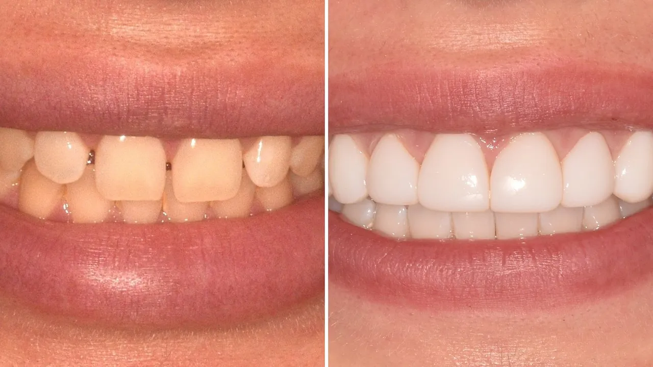 Before and after photographs of a smile treated with composite veneers at Radiant Dental, the left side showing uneven yellowed front teeth and the right side showing even, bright front teeth