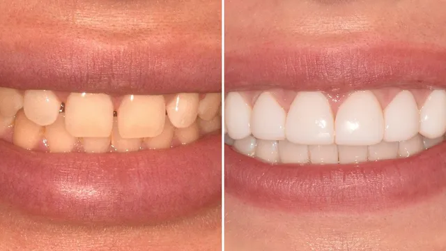 Before and after photographs of a smile treated with composite veneers at Radiant Dental, the left side showing uneven yellowed front teeth and the right side showing even, bright front teeth