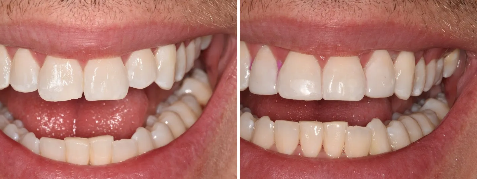 Before and after photographs of composite edge bonding carried out at Radiant Dental: on the left, front teeth with uneven biting edges; on the right, the same teeth with evened edges