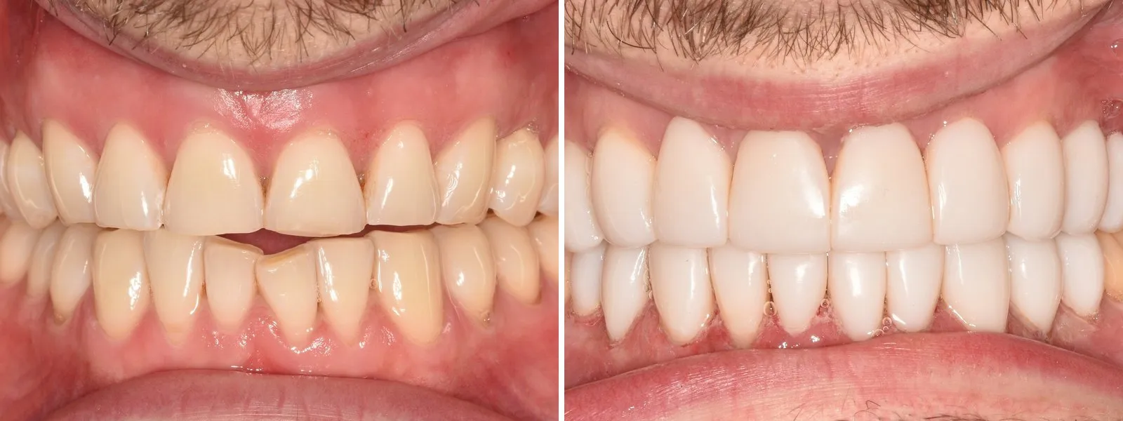 Before and after photographs of composite veneers carried out at Radiant Dental: on the left, worn, uneven and yellowed teeth; on the right, the same teeth with bright, evenly shaped front teeth