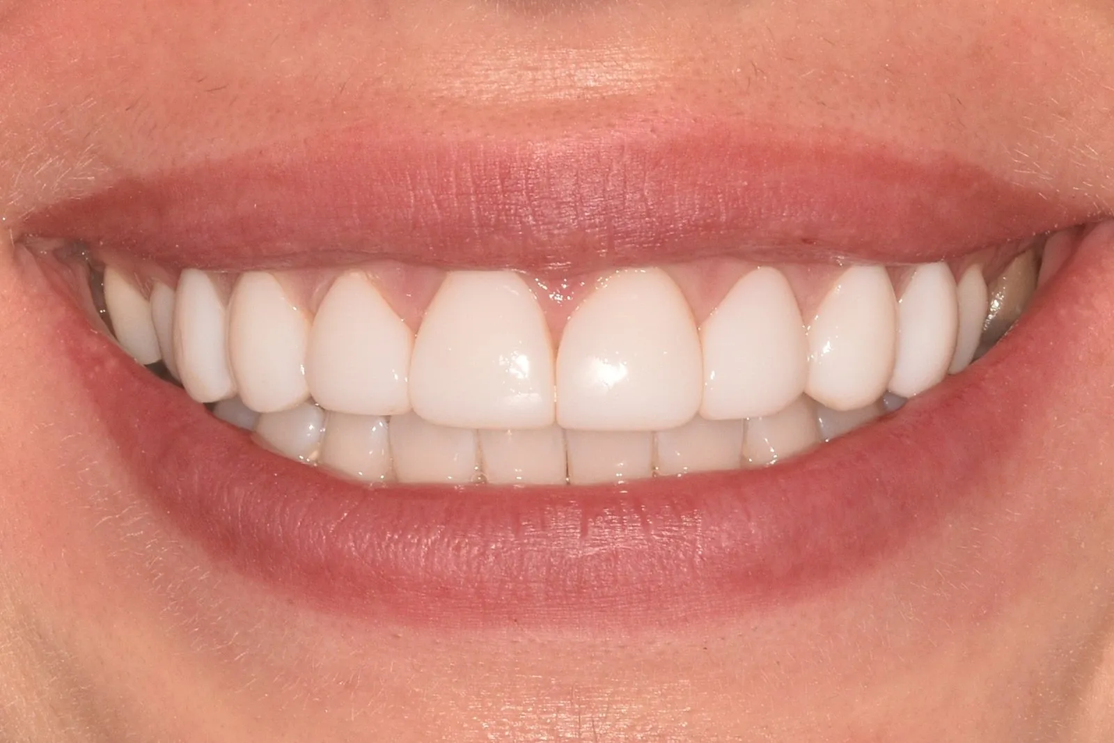 The same smile after composite veneers at Radiant Dental