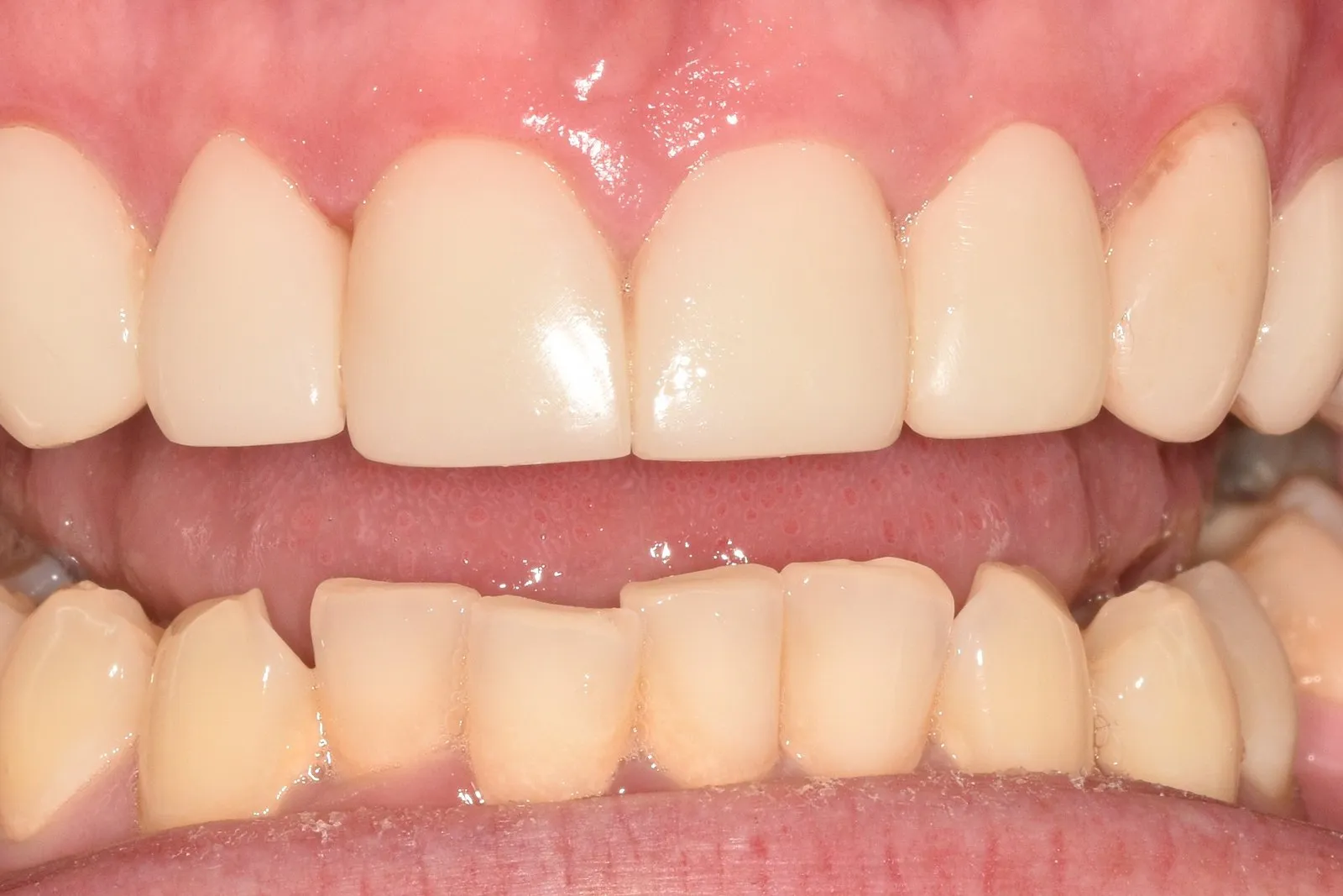 The same smile after composite veneers at Radiant Dental