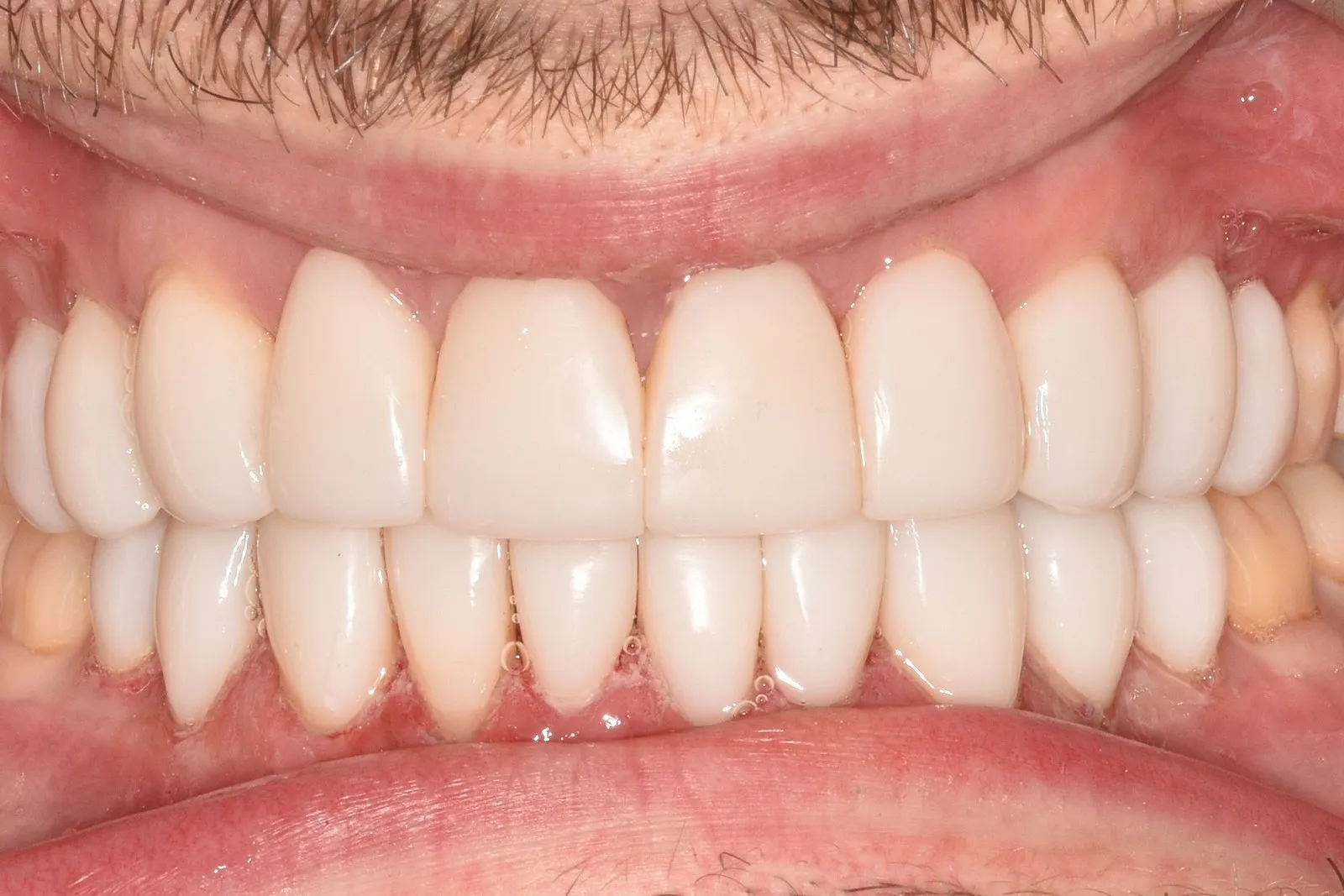 The same smile after composite veneers at Radiant Dental
