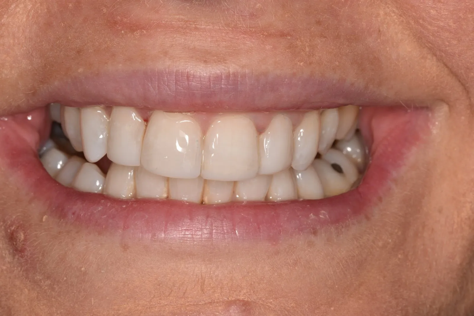 The same smile after composite edge bonding at Radiant Dental