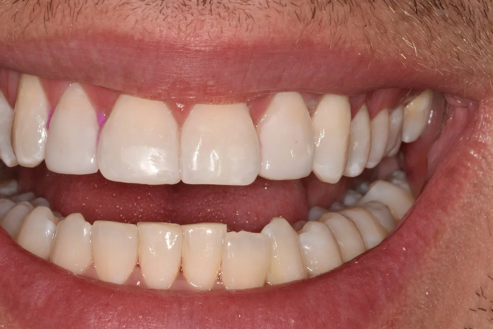 The same smile after composite edge bonding at Radiant Dental
