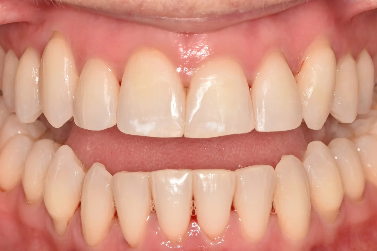 Patient 1’s smile after Invisalign treatment at Radiant Dental