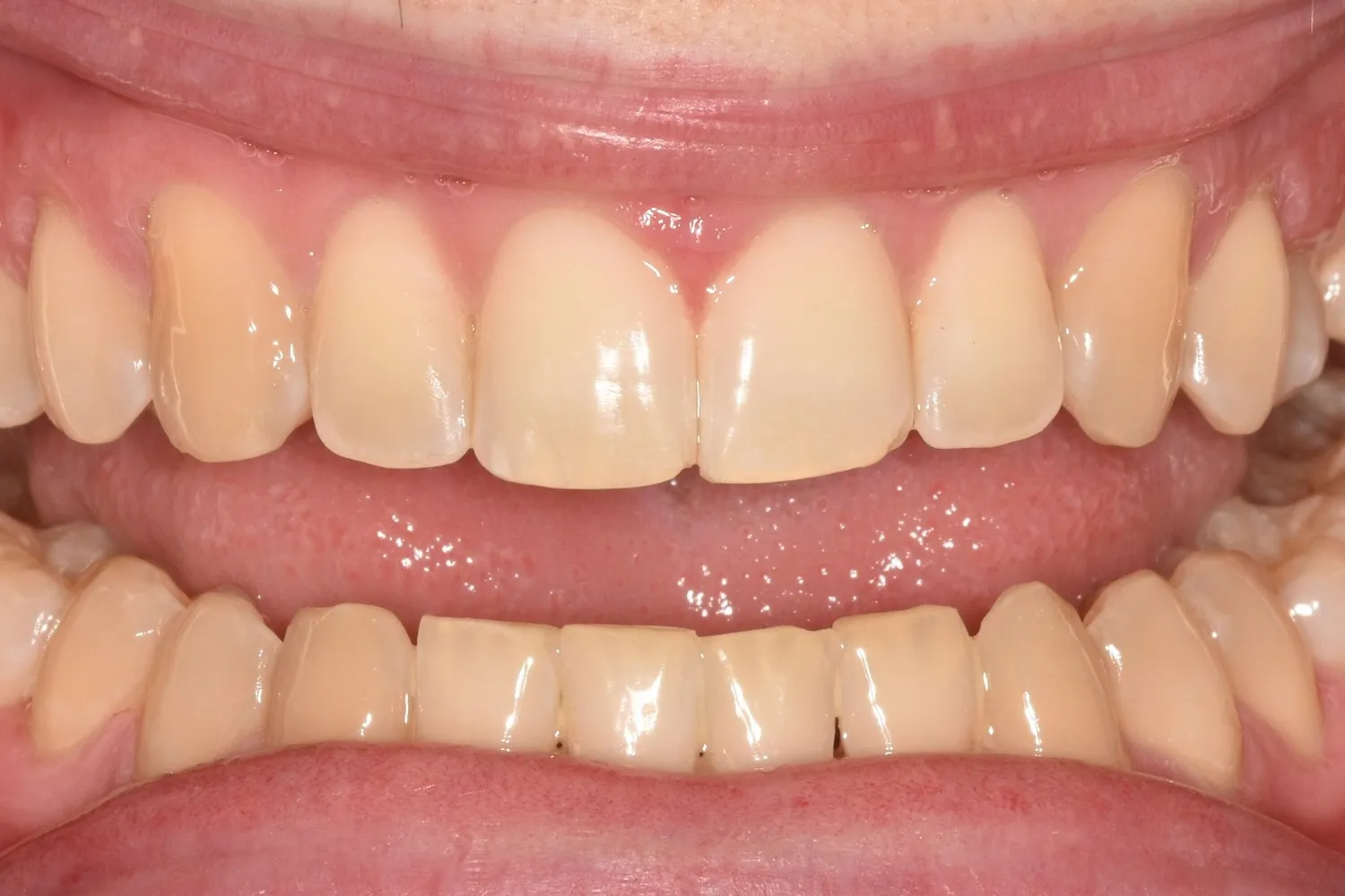 Patient 2’s smile after Invisalign treatment at Radiant Dental
