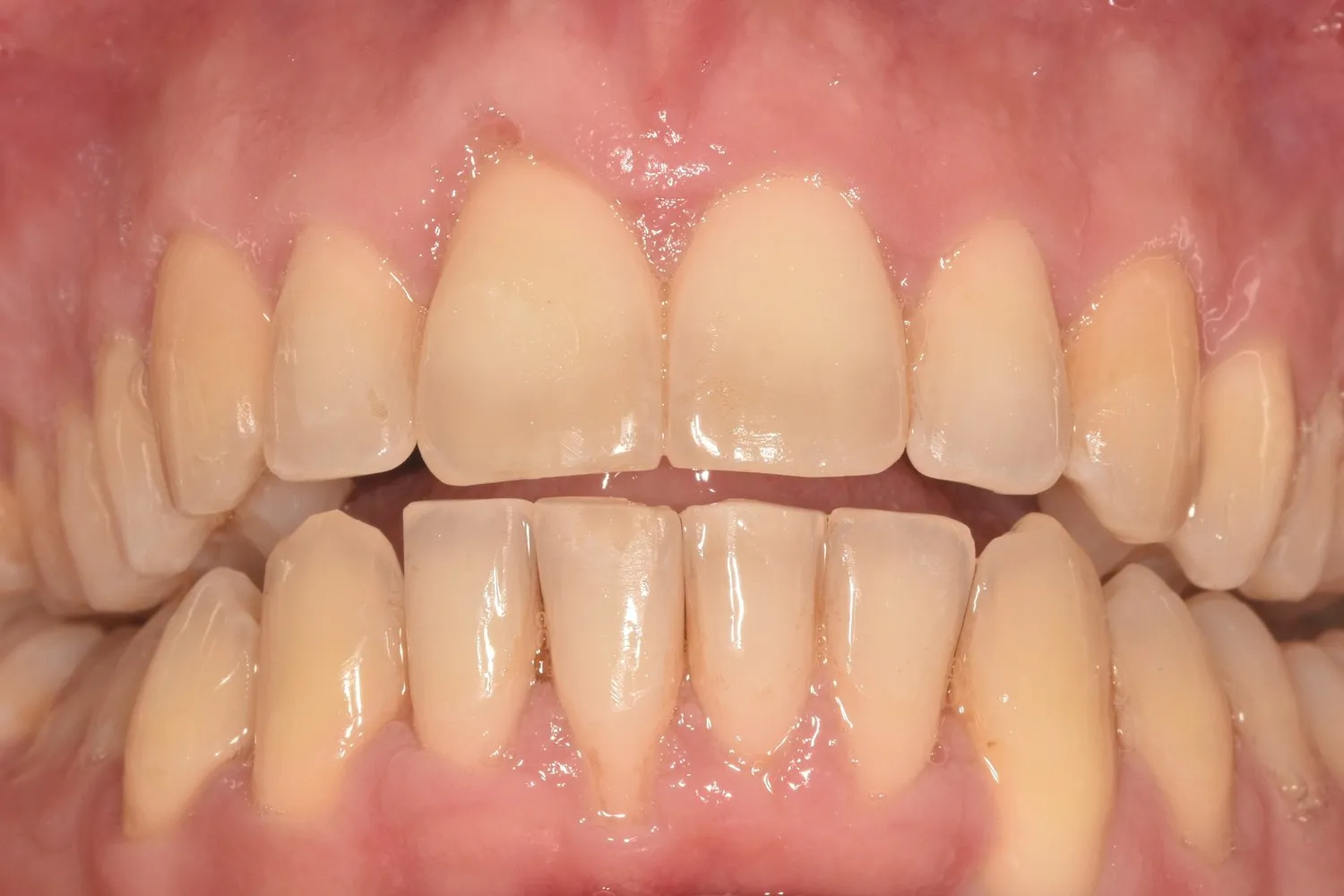 Patient 3’s smile after Invisalign treatment at Radiant Dental