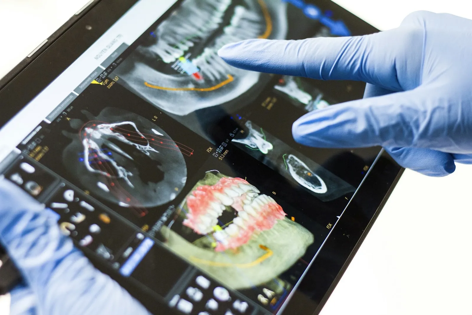 Digital 3D dental scan and smile simulation consultation on tablet